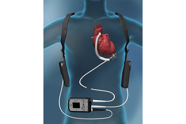 心臓移植までの橋渡し「植込型補助人工心臓（iVAD）」を知っていますか？