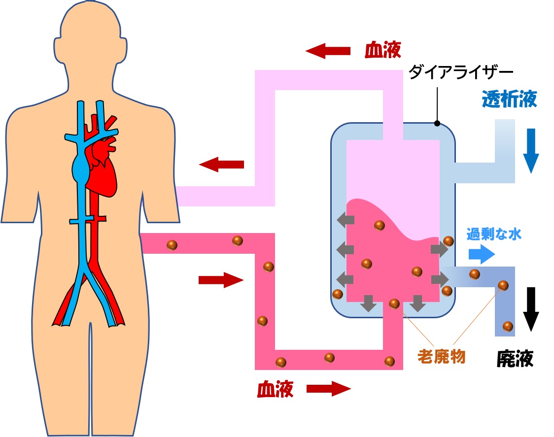臨床工学技士が活躍！人工透析治療と超音波装置について解説